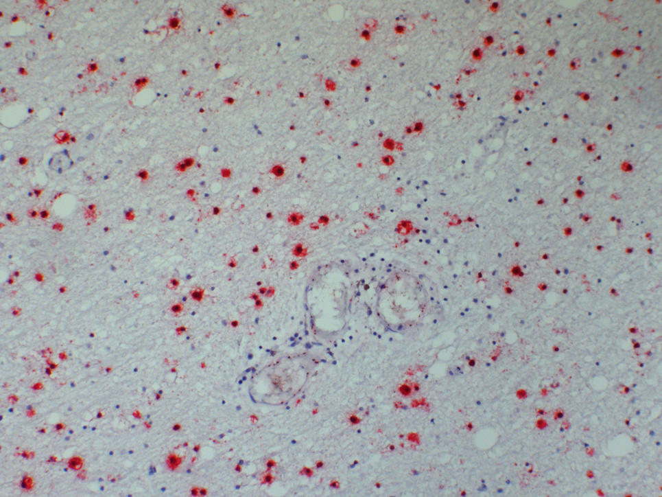 Mikroskopische Aufnahme des BoDV-1 (Borna Disease Virus 1) als in situ-Hybridisierung (RNA-Färbung, rot) im Nervengewebe. Bild: BNITM